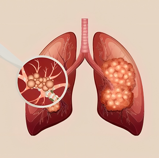 Interstitial Lung Diseases (ILD)