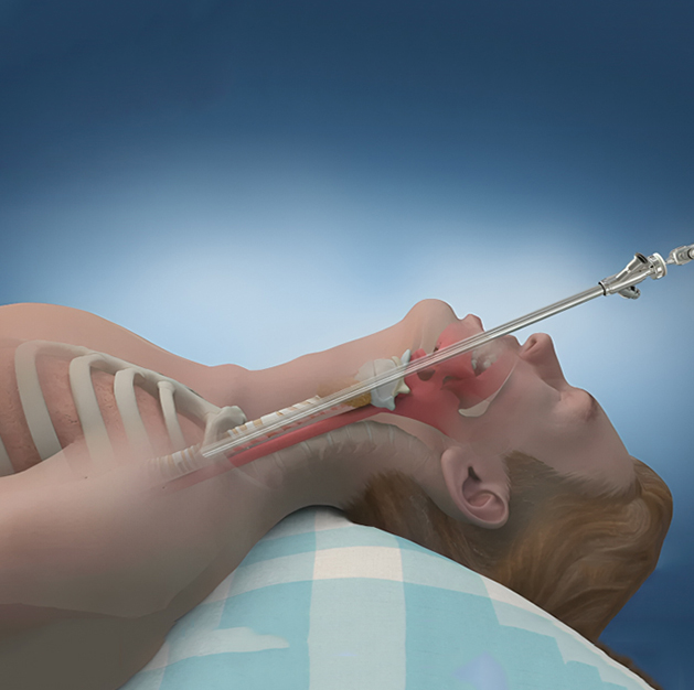 Fibreoptic Bronchoscopy